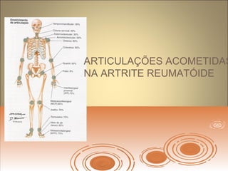 ARTICULAÇÕES ACOMETIDAS
NA ARTRITE REUMATÓIDE
 
