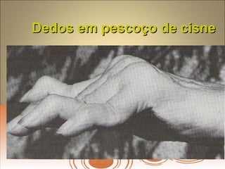 Dedos em pescoço de cisneDedos em pescoço de cisne
 