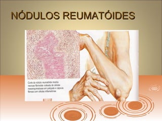 NÓDULOS REUMATÓIDESNÓDULOS REUMATÓIDES
 
