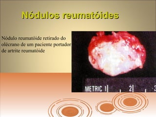 Nódulos reumatóidesNódulos reumatóides
Nódulo reumatóide retirado do
olécrano de um paciente portador
de artrite reumatóide
 