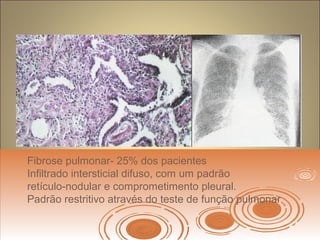 Fibrose pulmonar- 25% dos pacientes
Infiltrado intersticial difuso, com um padrão
retículo-nodular e comprometimento pleural.
Padrão restritivo através do teste de função pulmonar
 