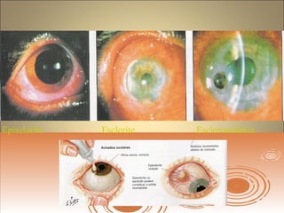 Episclerite Esclerite Escleromalácia
 
