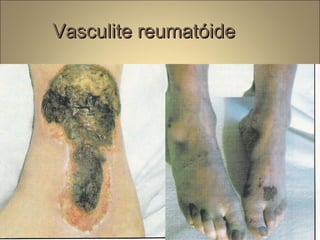 Vasculite reumatóideVasculite reumatóide
 