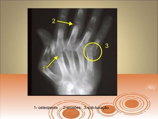 1- osteopenia 2-erosões 3-sub-luxação
 