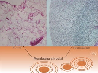 Membrana sinovial
Normal reumatóide
 