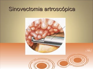 Sinovectomia artroscópicaSinovectomia artroscópica
 