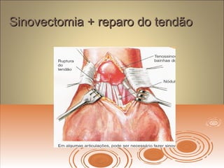 Sinovectomia + reparo do tendãoSinovectomia + reparo do tendão
 