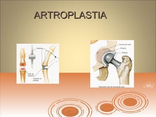 ARTROPLASTIAARTROPLASTIA
 
