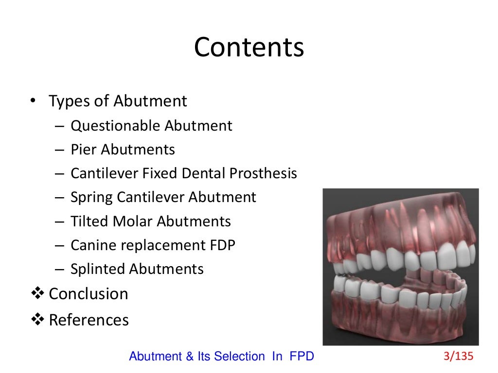 Abutment & Its Selection In Fixed Partial Denture