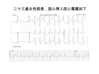 二十三歲女性病患，因心悸入院心電圖如下 