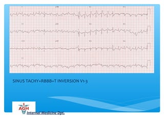 SINUS TACHY+RBBB+T INVERSION V1-3
Internal Medicine Dpt.
 