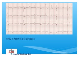 RBBB+S1Q3T3+R axis deviation
Internal Medicine Dpt.
 