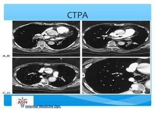 CTPA
Internal Medicine Dpt.
 