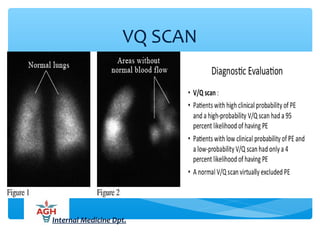VQ SCAN
Internal Medicine Dpt.
 