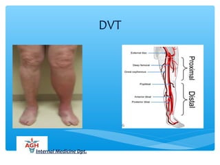 DVT
Internal Medicine Dpt.
 