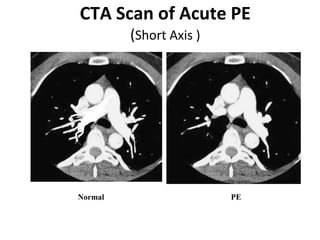 Venous Thrombosis Emboli disease and how to manage it | PPTX