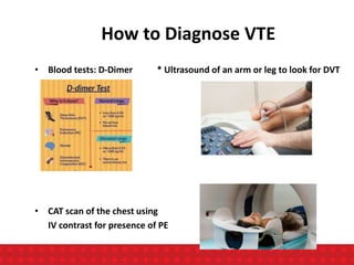 • Blood tests: D-Dimer * Ultrasound of an arm or leg to look for DVT
• CAT scan of the chest using
IV contrast for presence of PE
How to Diagnose VTE
 