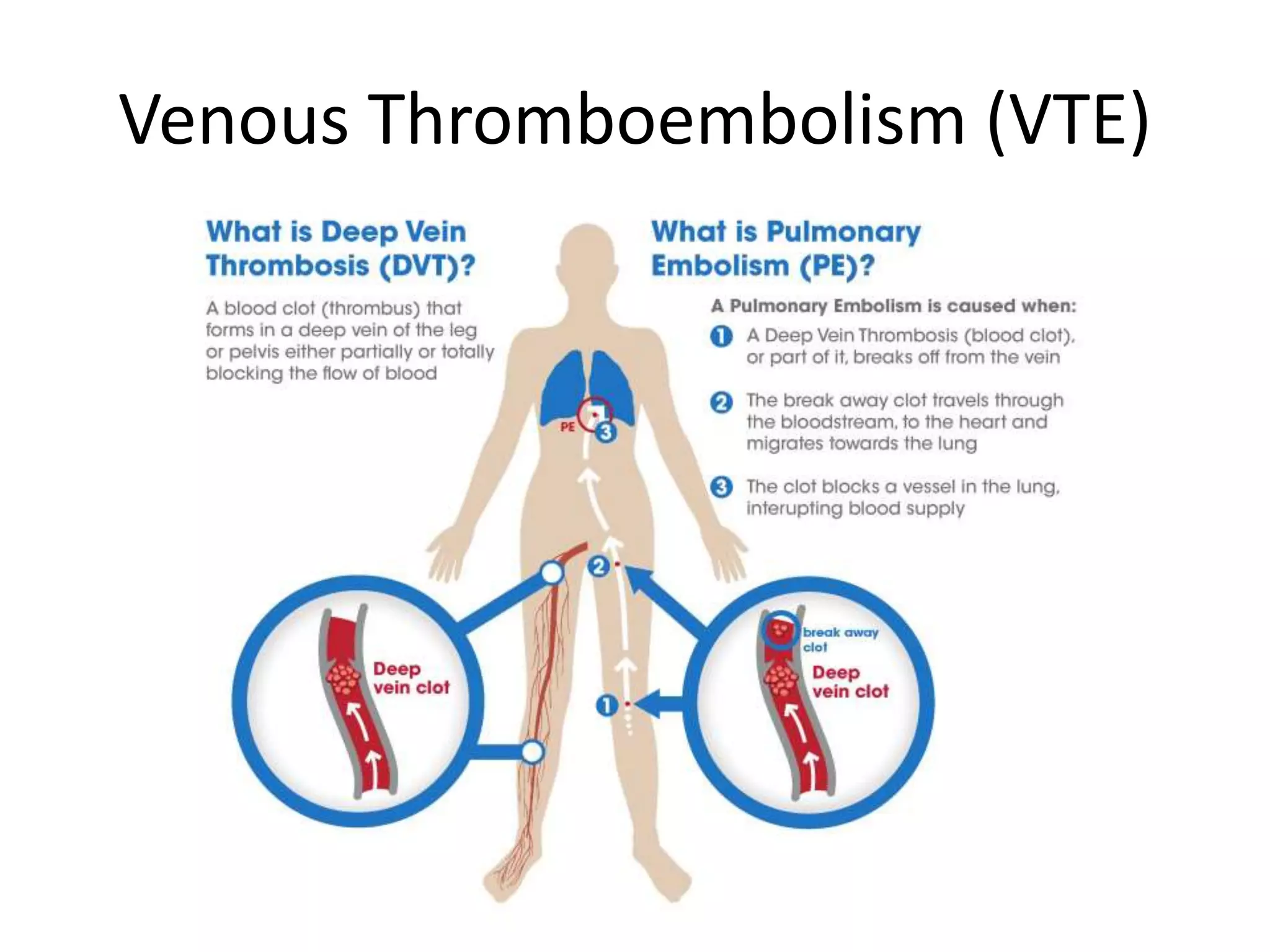 Venous thromboembolism of pregnancy | PPTX