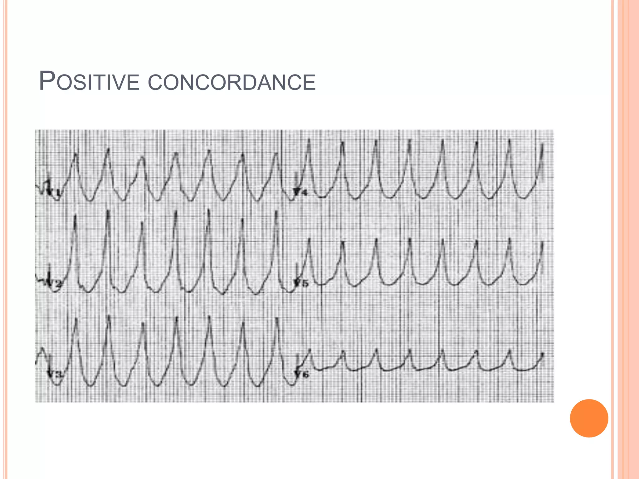 POSITIVE CONCORDANCE
 