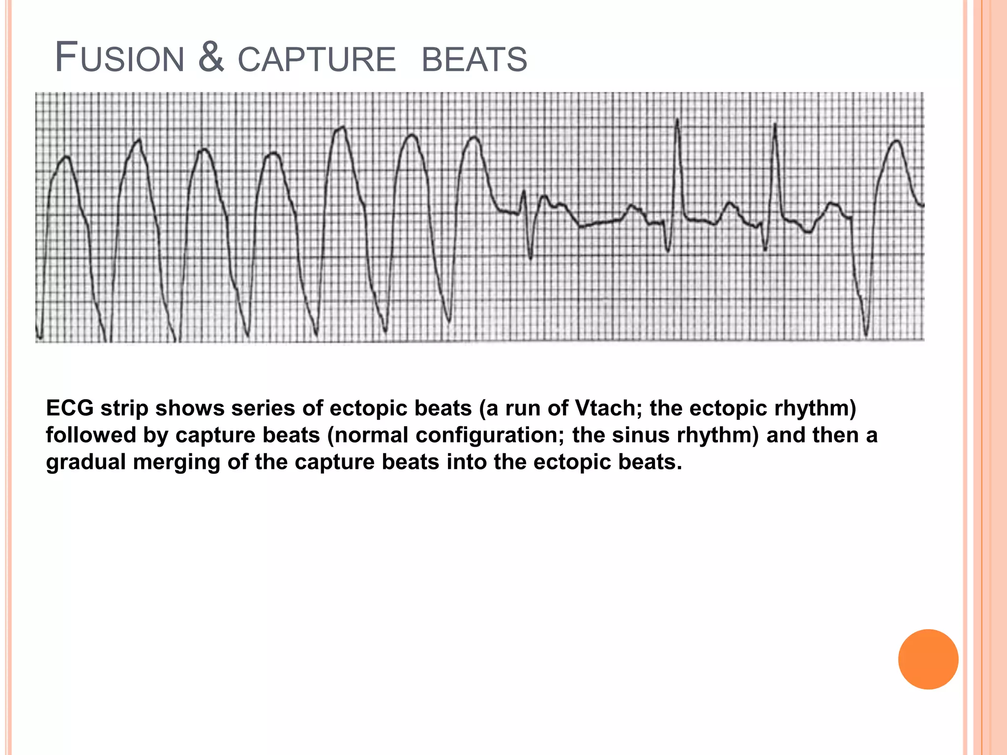 FUSION & CAPTURE BEATS
ECG strip shows series of ectopic beats (a run of Vtach; the ectopic rhythm)
followed by capture beats (normal configuration; the sinus rhythm) and then a
gradual merging of the capture beats into the ectopic beats.
 