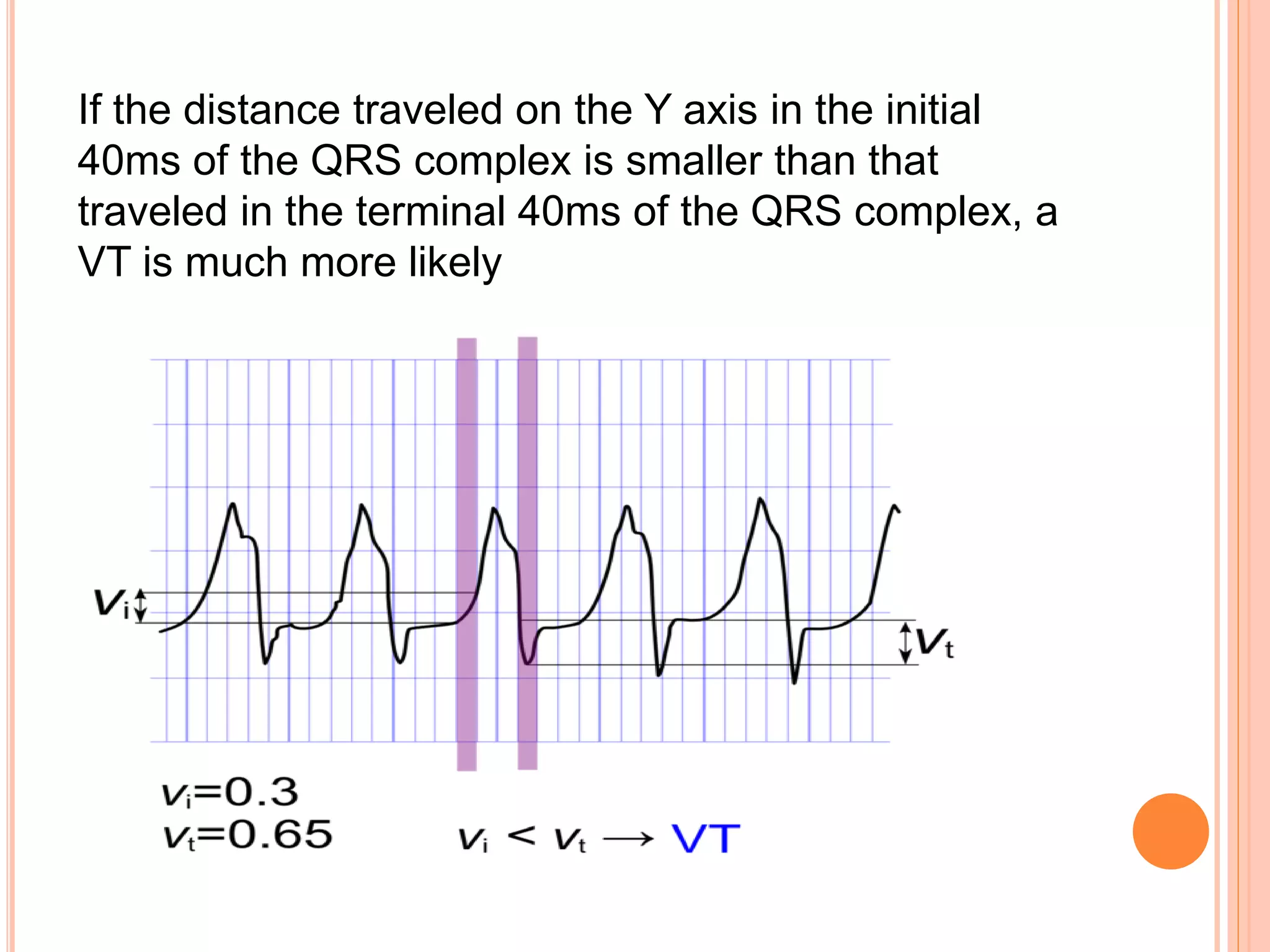 If the distance traveled on the Y axis in the initial
40ms of the QRS complex is smaller than that
traveled in the terminal 40ms of the QRS complex, a
VT is much more likely
 