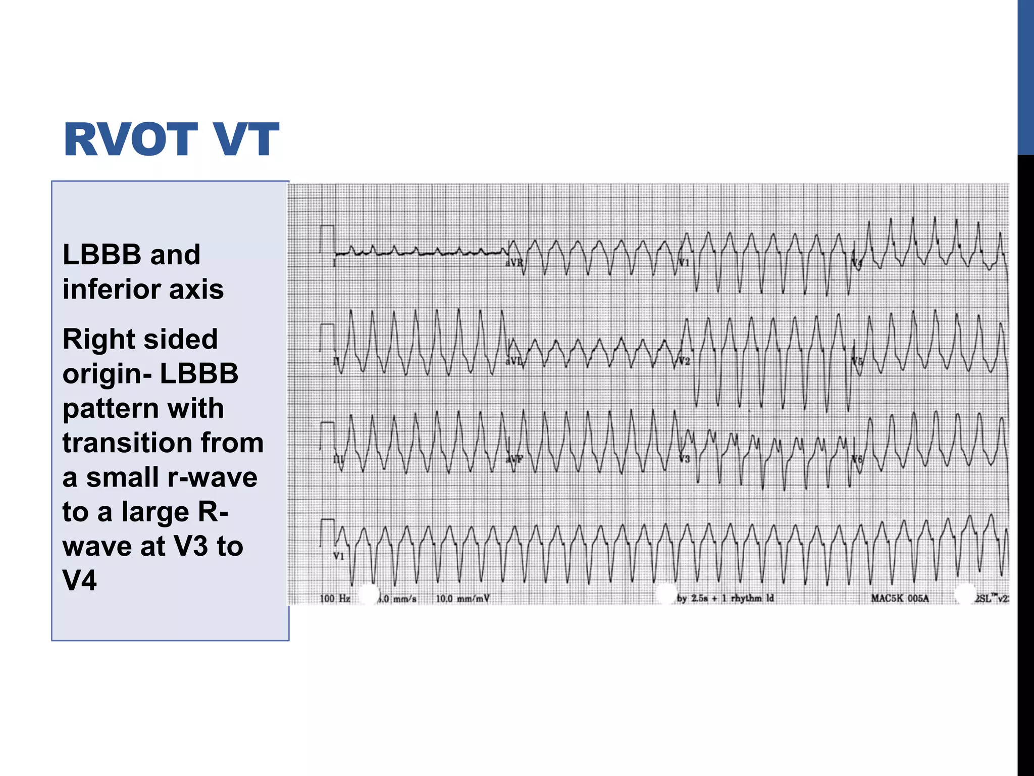 LBBB and
inferior axis
Right sided
origin- LBBB
pattern with
transition from
a small r-wave
to a large R-
wave at V3 to
V4
RVOT VT
 
