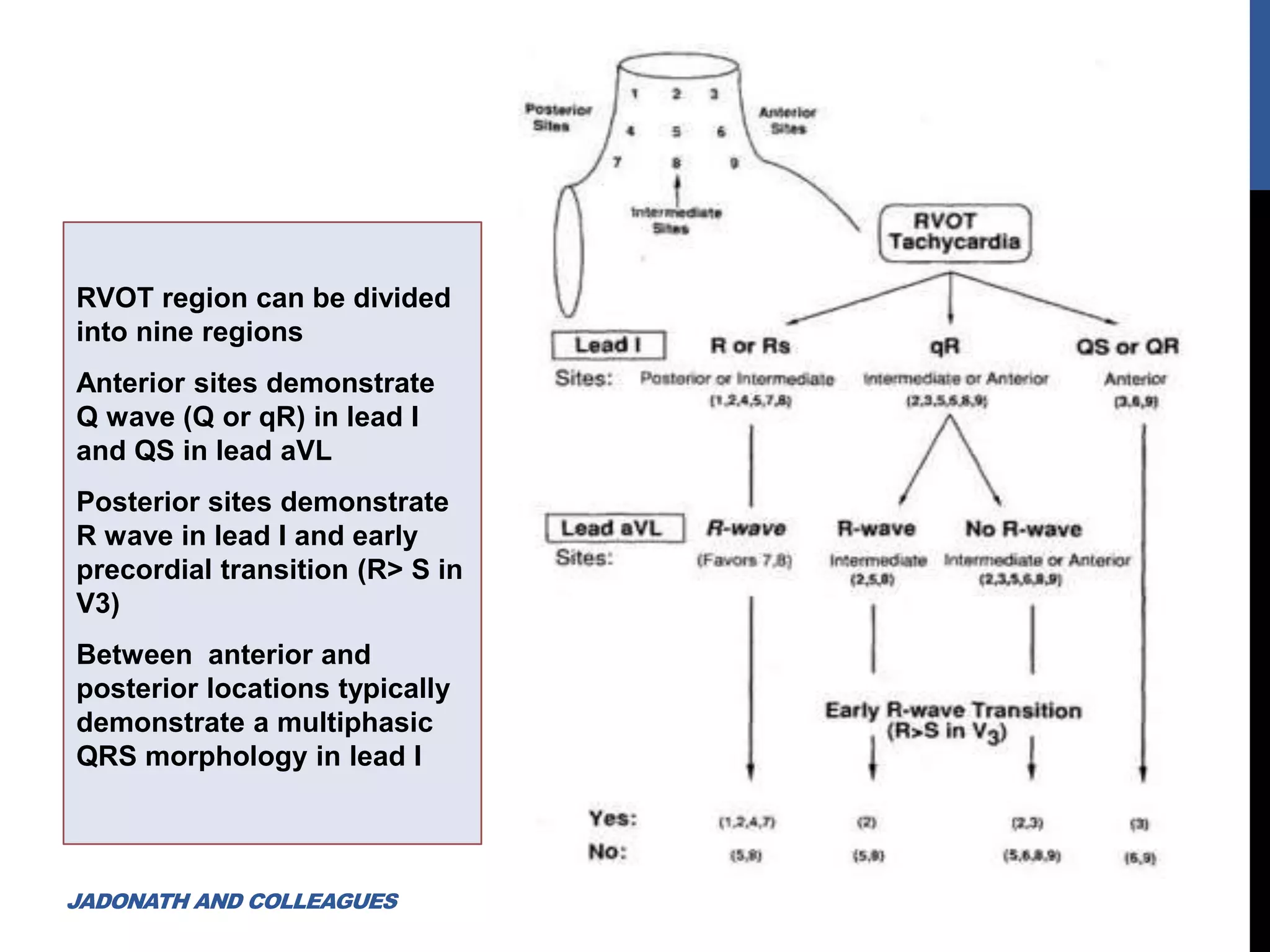 RVOT region can be divided
into nine regions
Anterior sites demonstrate
Q wave (Q or qR) in lead I
and QS in lead aVL
Posterior sites demonstrate
R wave in lead I and early
precordial transition (R> S in
V3)
Between anterior and
posterior locations typically
demonstrate a multiphasic
QRS morphology in lead I
JADONATH AND COLLEAGUES
 