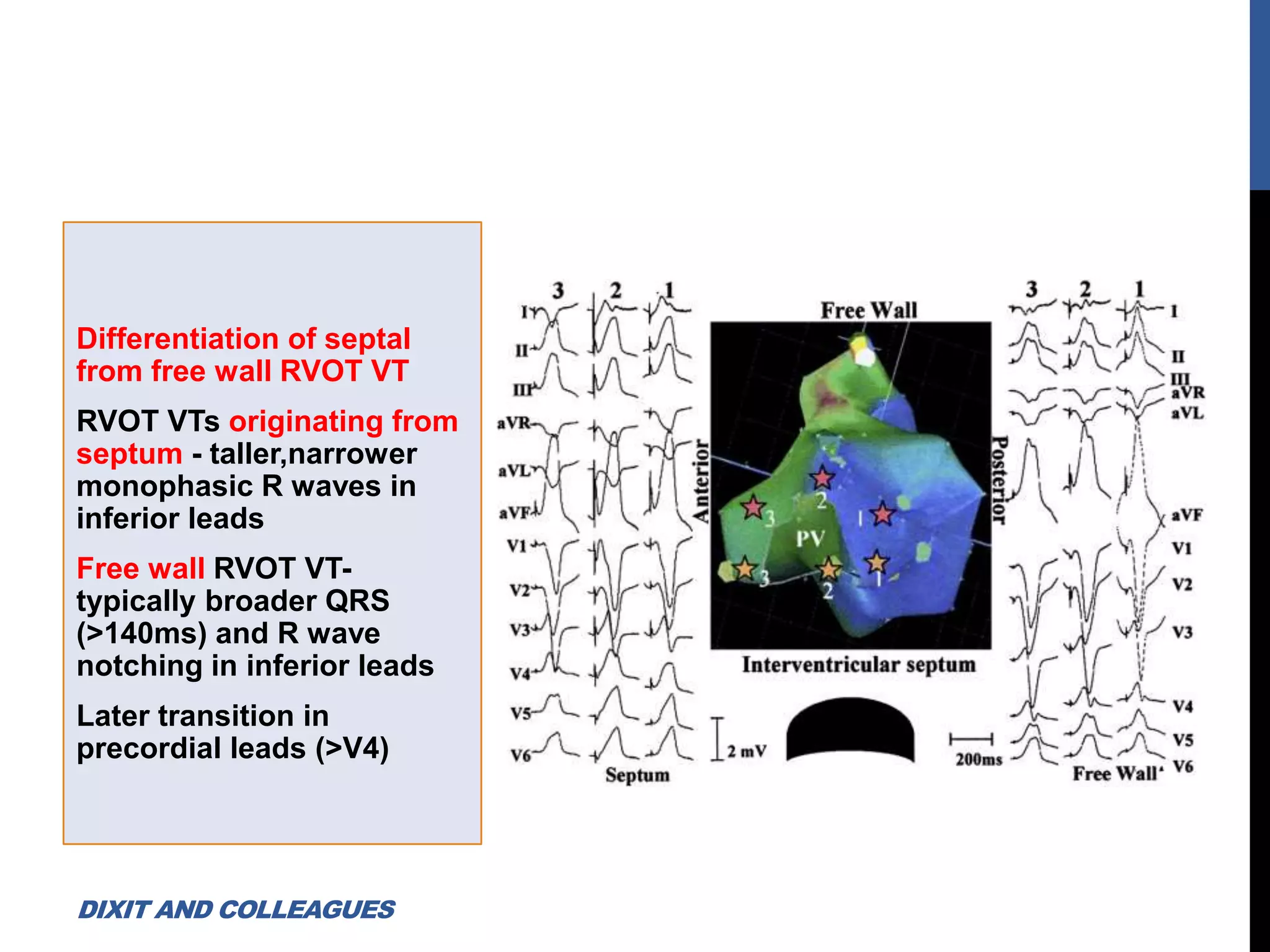 Differentiation of septal
from free wall RVOT VT
RVOT VTs originating from
septum - taller,narrower
monophasic R waves in
inferior leads
Free wall RVOT VT-
typically broader QRS
(>140ms) and R wave
notching in inferior leads
Later transition in
precordial leads (>V4)
DIXIT AND COLLEAGUES
 