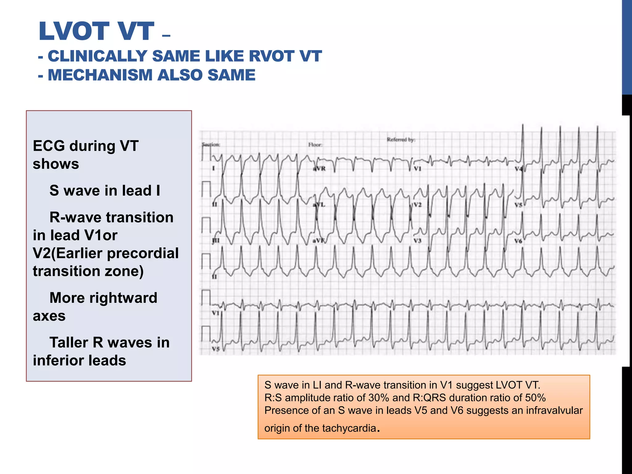 ECG during VT
shows
S wave in lead I
R-wave transition
in lead V1or
V2(Earlier precordial
transition zone)
More rightward
axes
Taller R waves in
inferior leads
LVOT VT –
- CLINICALLY SAME LIKE RVOT VT
- MECHANISM ALSO SAME
S wave in LI and R-wave transition in V1 suggest LVOT VT.
R:S amplitude ratio of 30% and R:QRS duration ratio of 50%
Presence of an S wave in leads V5 and V6 suggests an infravalvular
origin of the tachycardia.
 