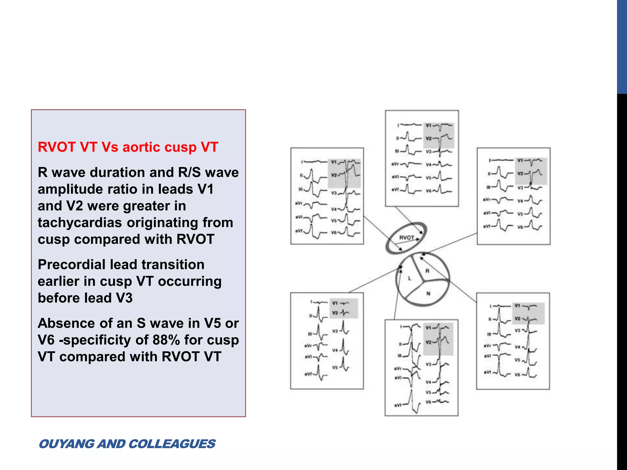 RVOT VT Vs aortic cusp VT
R wave duration and R/S wave
amplitude ratio in leads V1
and V2 were greater in
tachycardias originating from
cusp compared with RVOT
Precordial lead transition
earlier in cusp VT occurring
before lead V3
Absence of an S wave in V5 or
V6 -specificity of 88% for cusp
VT compared with RVOT VT
OUYANG AND COLLEAGUES
 