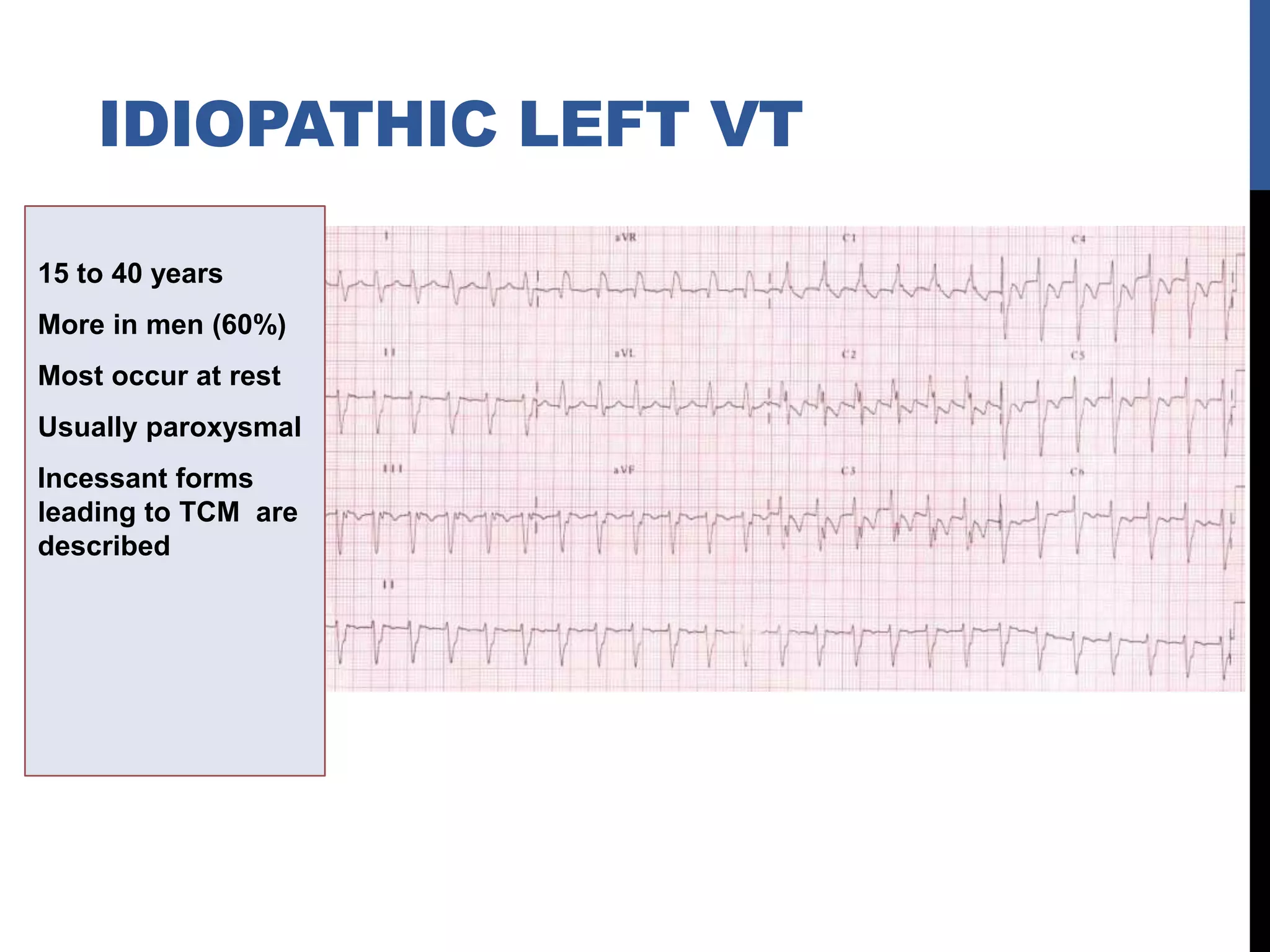 15 to 40 years
More in men (60%)
Most occur at rest
Usually paroxysmal
Incessant forms
leading to TCM are
described
IDIOPATHIC LEFT VT
 