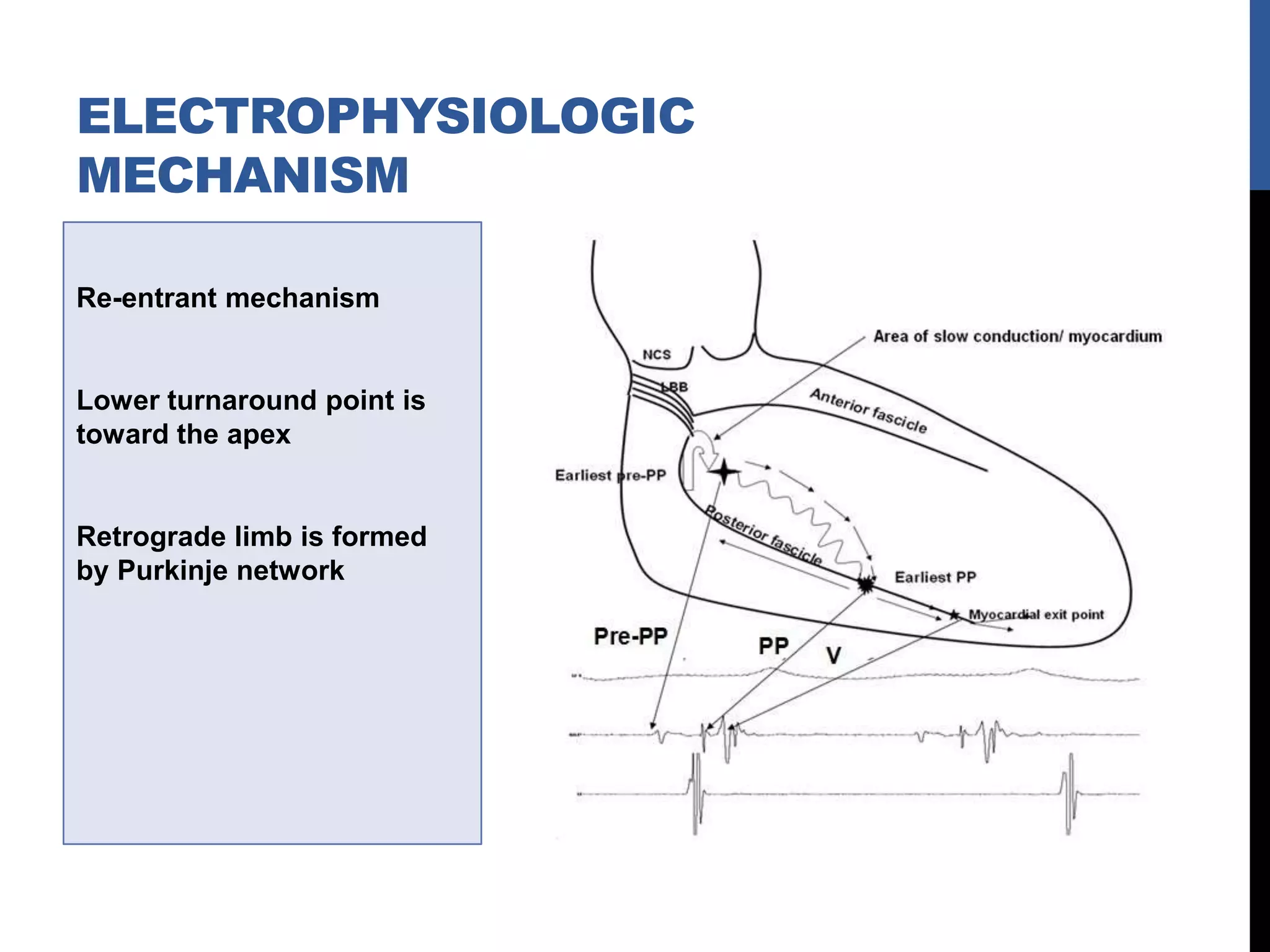Re-entrant mechanism
Lower turnaround point is
toward the apex
Retrograde limb is formed
by Purkinje network
ELECTROPHYSIOLOGIC
MECHANISM
 