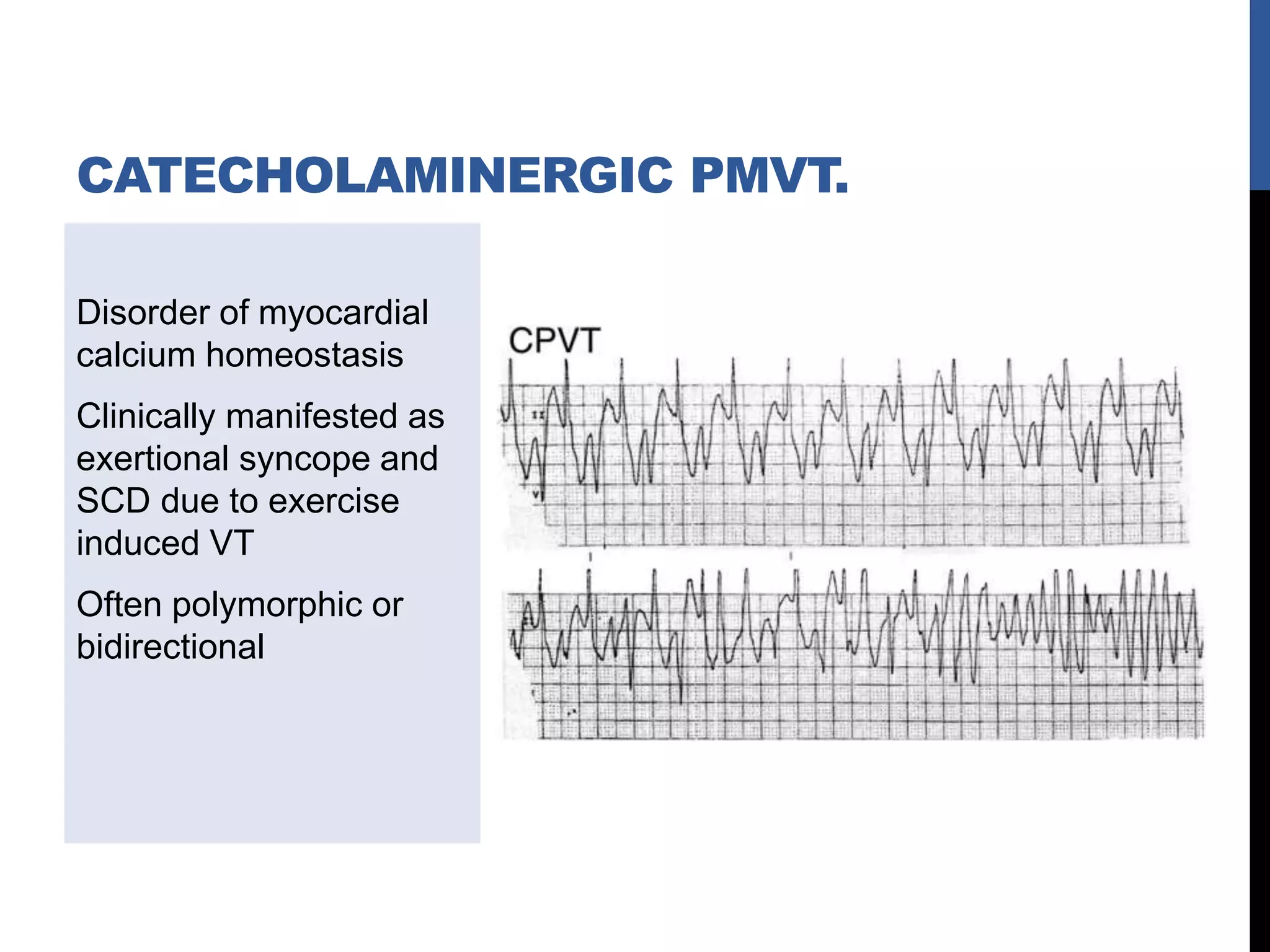 Disorder of myocardial
calcium homeostasis
Clinically manifested as
exertional syncope and
SCD due to exercise
induced VT
Often polymorphic or
bidirectional
CATECHOLAMINERGIC PMVT.
 