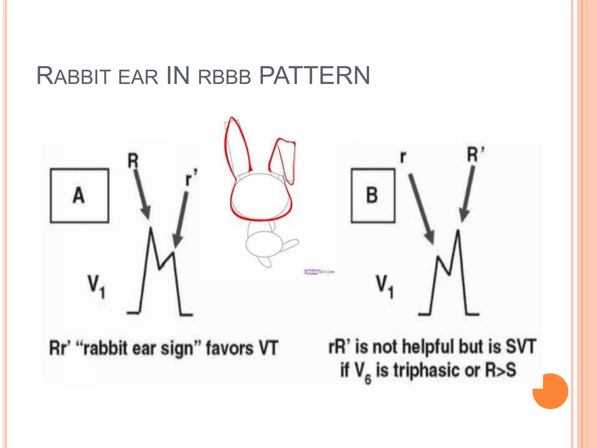 RABBIT EAR IN RBBB PATTERN
 