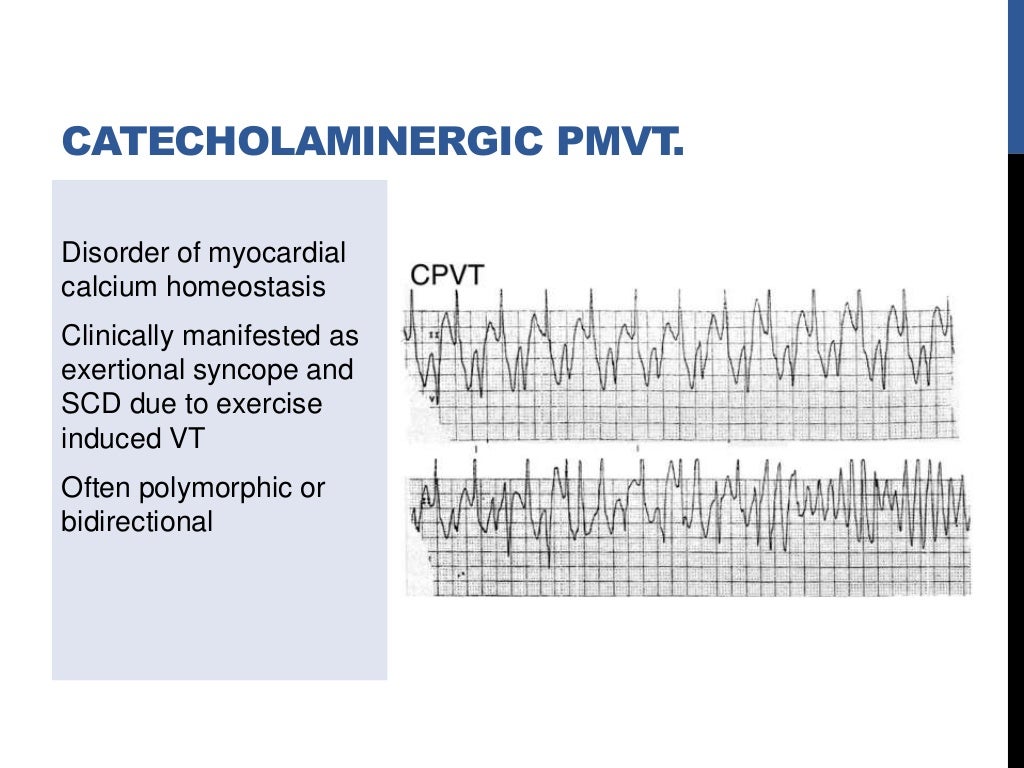 VT in structurally normal heart