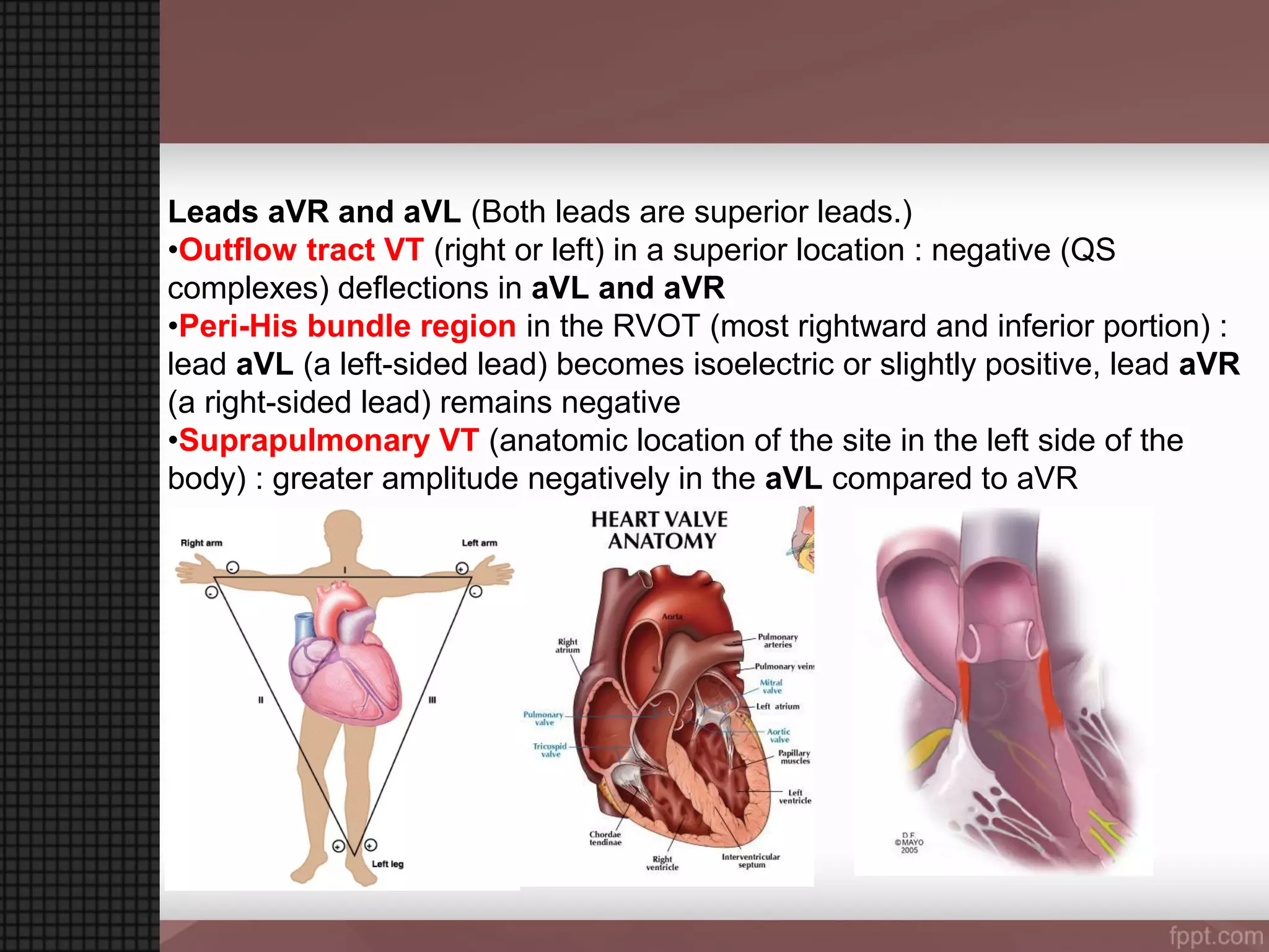 ventricular tachycardia (VT) Localisation | PPT