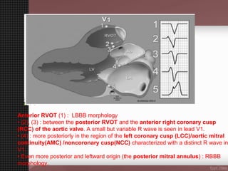 ventricular tachycardia (VT) Localisation | PPT