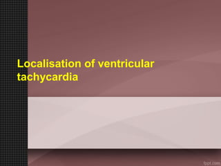 Localisation of ventricular
tachycardia
 