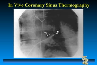 CS
Th
In Vivo Coronary Sinus ThermographyIn Vivo Coronary Sinus Thermography
 