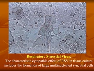 Respiratory Syncytial Virus.
The characteristic cytopathic effect of RSV in tissue culture
includes the formation of large multinucleated syncytial cells.
 