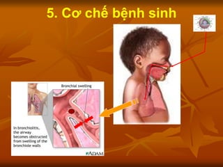 5. Cơ chế bệnh sinh
 