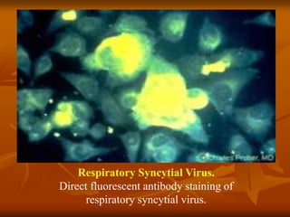 Respiratory Syncytial Virus.
Direct fluorescent antibody staining of
respiratory syncytial virus.
 