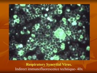 Respiratory Syncytial Virus.
Indirect immunofluorescence technique- 40x
 