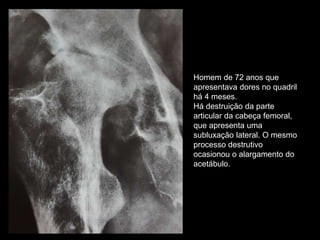 Homem de 72 anos que
apresentava dores no quadril
há 4 meses.
Há destruição da parte
articular da cabeça femoral,
que apresenta uma
subluxação lateral. O mesmo
processo destrutivo
ocasionou o alargamento do
acetábulo.
 