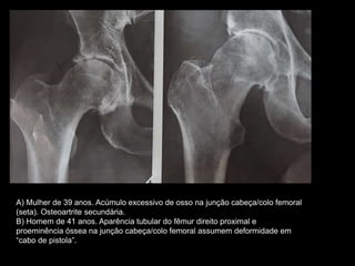 A) Mulher de 39 anos. Acúmulo excessivo de osso na junção cabeça/colo femoral
(seta). Osteoartrite secundária.
B) Homem de 41 anos. Aparência tubular do fêmur direito proximal e
proeminência óssea na junção cabeça/colo femoral assumem deformidade em
“cabo de pistola”.
 