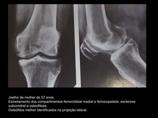 Joelho de mulher de 57 anos.
Estreitamento dos compartimentos femorotibial medial e femoropatelar, esclerose
subcondral e osteofitose.
Osteófitos melhor identificados na projeção lateral.
 