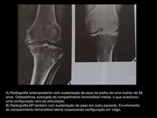 A) Radiografia anteroposterior com sustentação de peso do joelho de uma mulher de 58
anos. Osteoartrose avançada do compartimento femorotibial medial, o que ocasionou
uma configuração varo da articulação.
B) Radiografia AP também com sustentação de peso em outro paciente. Envolvimento
do compartimento femorotibial lateral ocasionando configuração em valgo.
 