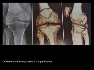 Osteoartrose avançada nos 3 compartimentos.
 