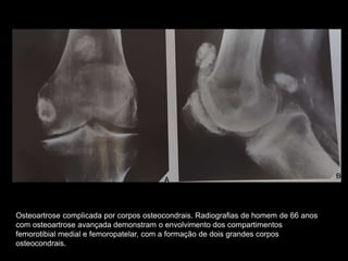 Osteoartrose complicada por corpos osteocondrais. Radiografias de homem de 66 anos
com osteoartrose avançada demonstram o envolvimento dos compartimentos
femorotibial medial e femoropatelar, com a formação de dois grandes corpos
osteocondrais.
 