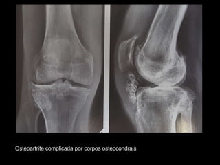 Osteoartrite complicada por corpos osteocondrais.
 